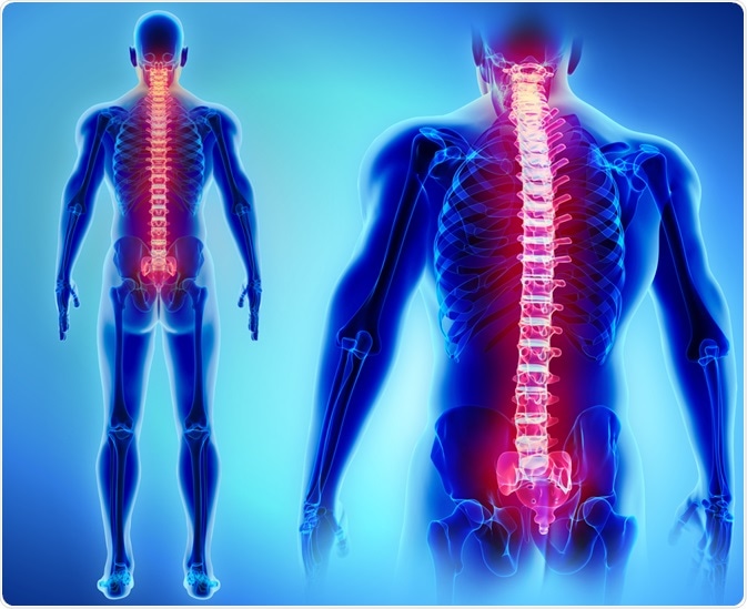 Spondylitis